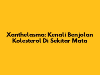 Xanthelasma: Kenali Benjolan Kolesterol Di Sekitar Mata
